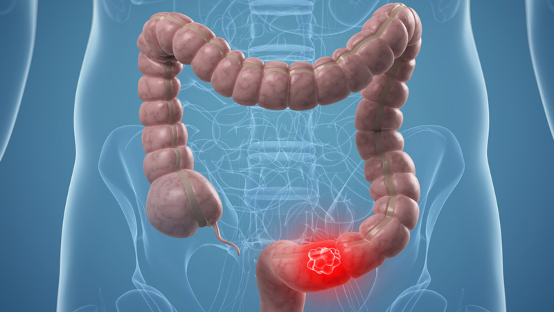 دانستنی ها در مورد سرطان روده