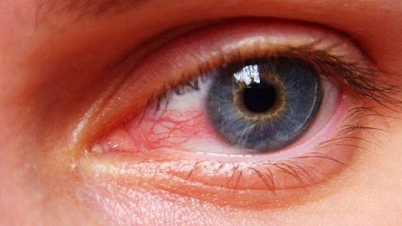 آشنایی با بیماری های چشم