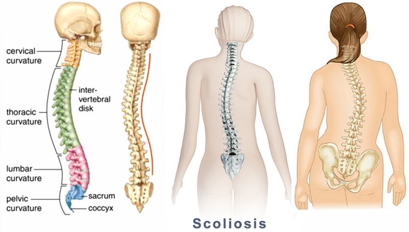درباره بیماری اسکولیوز چه می دانید