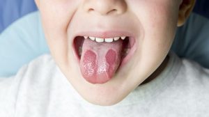درمان سوختگی زبان با ماست