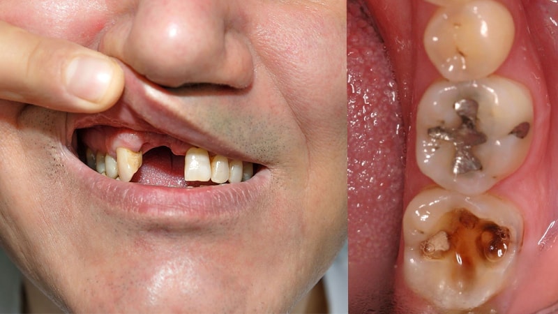 پوسیدگی دندان به چه عواملی بستگی دارد