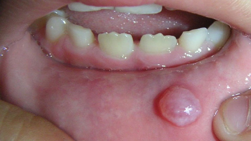 درمان آفت دهان به روش خانگی