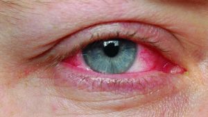 عفونت چشمی را با چای سبز درمان کنید