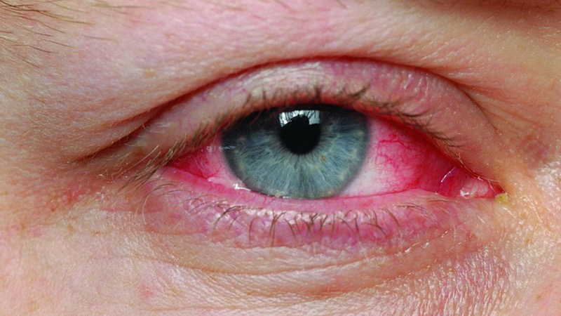 عفونت چشمی را با چای سبز درمان کنید