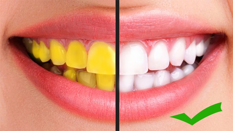 چه موادی دندان را زرد و چه موادی سفید می کند