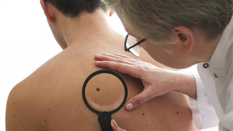 چه زمانی یک خال خطرناک می شود و احتمال سرطان پوست وجود دارد؟
