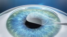جراحی چشم به روش اسمایل